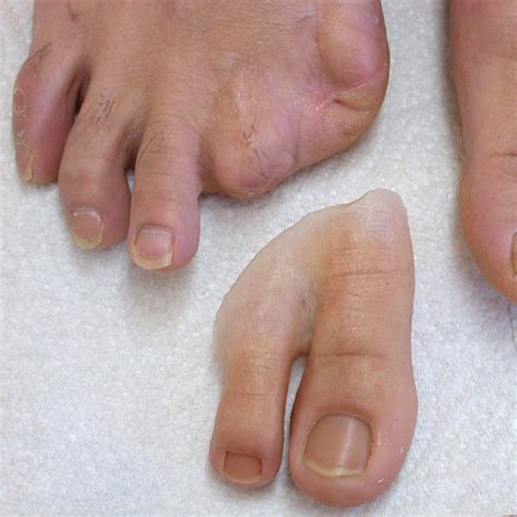 prosthetics for missing toes